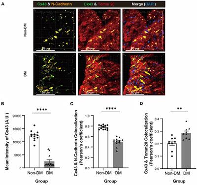 Hypoglycemia-Exacerbated Mitochondrial Connexin 43 Accumulation Aggravates Cardiac Dysfunction in Diabetic Cardiomyopathy